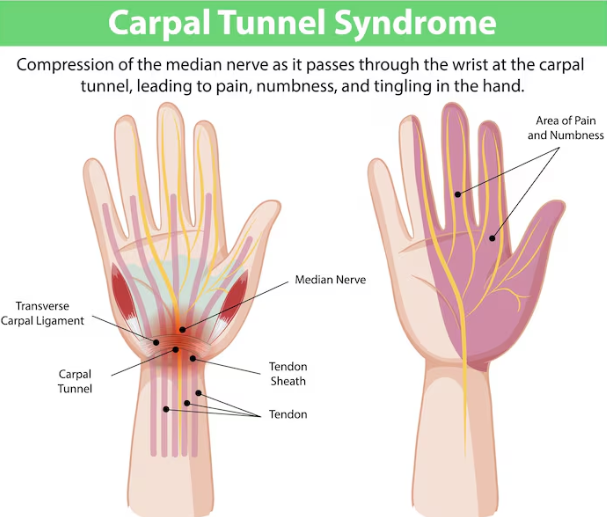 carpal-tunnel-syndrome