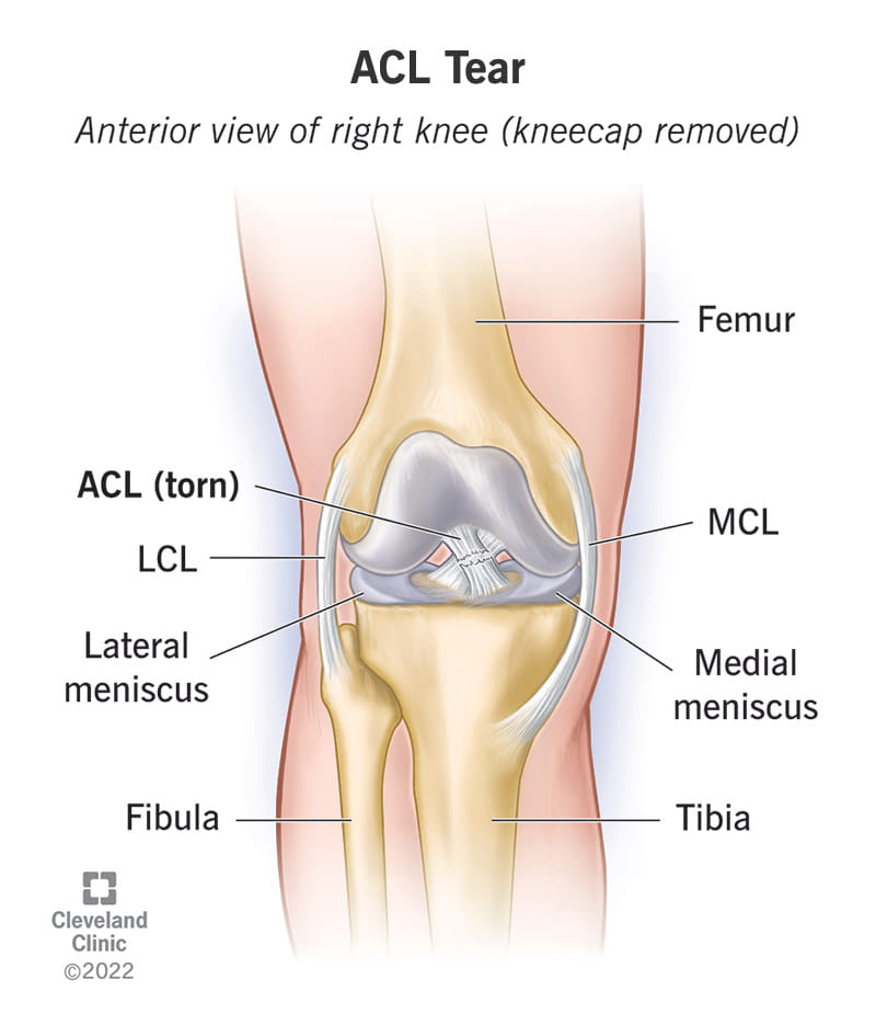 acl-injury-cara-berkesan-bantu-pulih