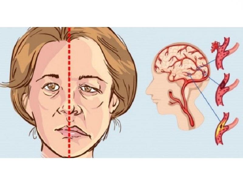 iswanah-physiotherapy-for-minor-stroke