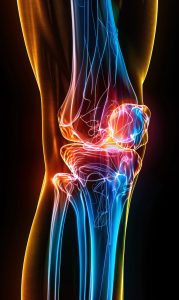 acl-injury-proven-ways-physiotherapy-help2