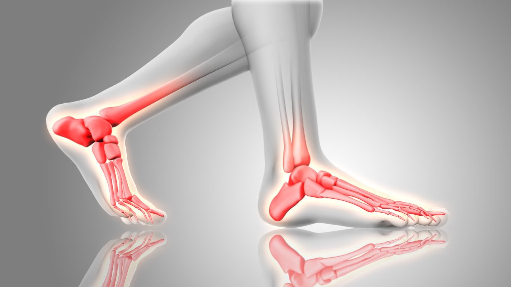 ankle sprain